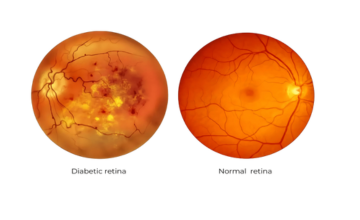 Diabetic Eye Care