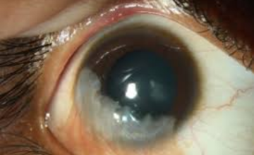Limbal Stem Cell Deficiency
