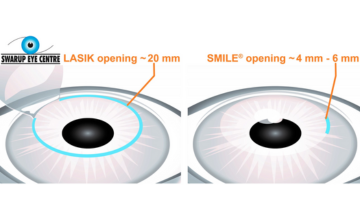SMILE Eye Surgery